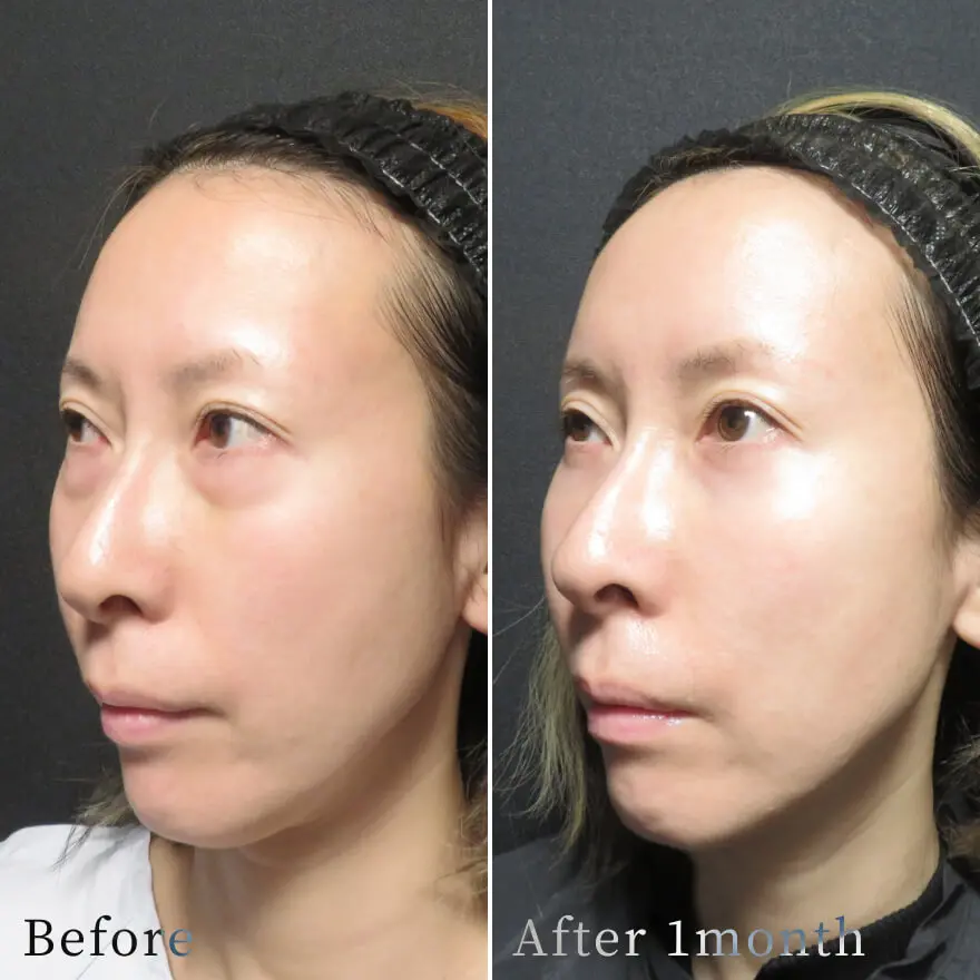 ビフォーアフター写真