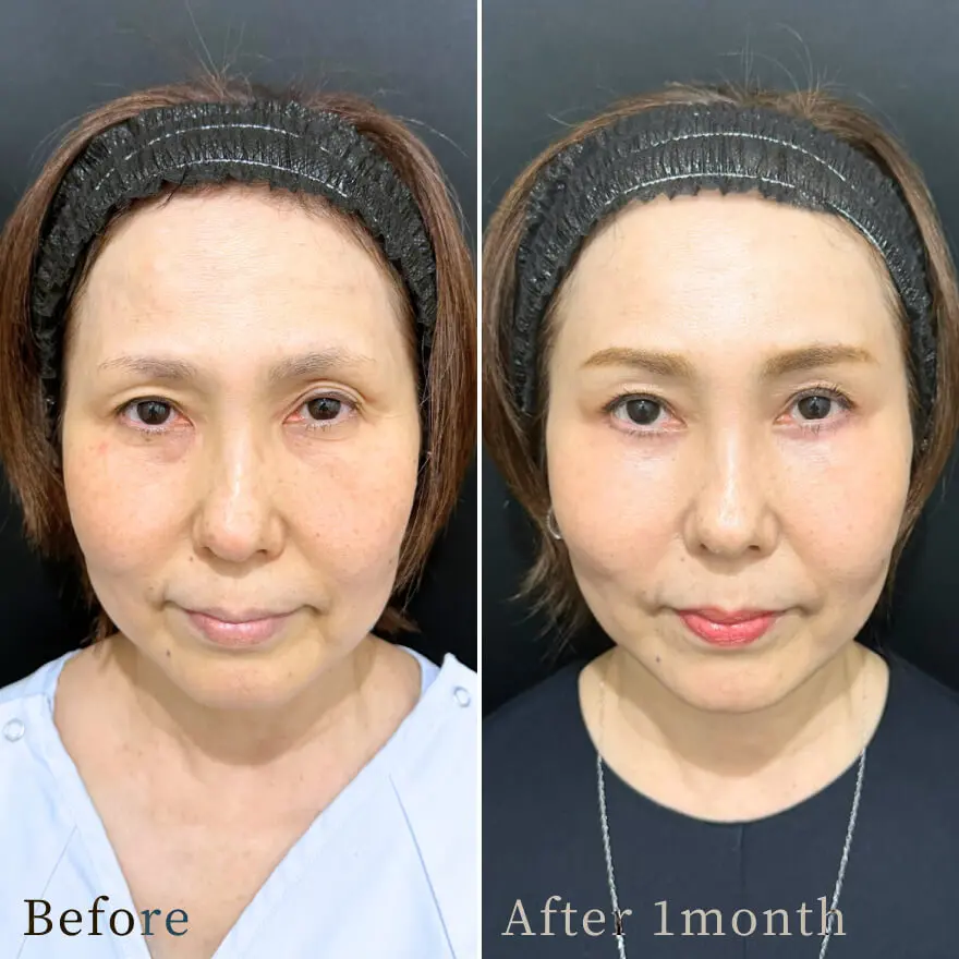 ビフォーアフター写真