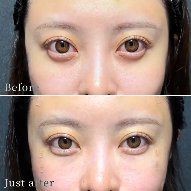 ビフォーアフター写真