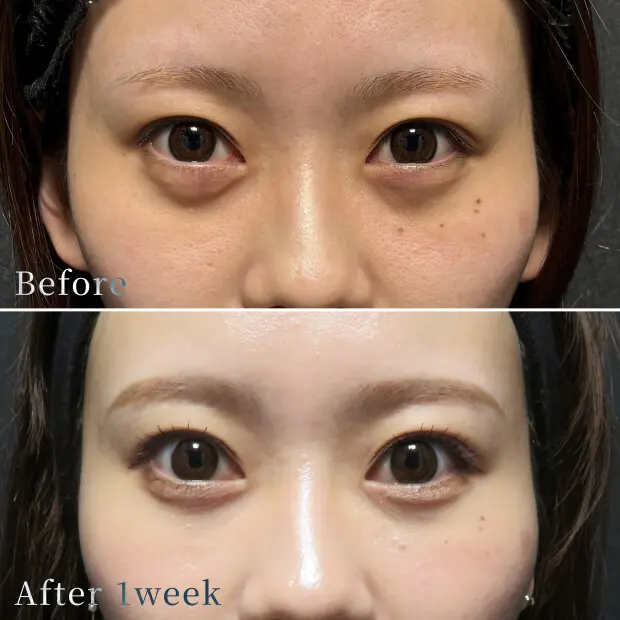 ビフォーアフター写真