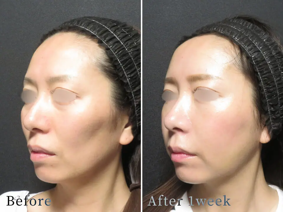 ビフォーアフター写真