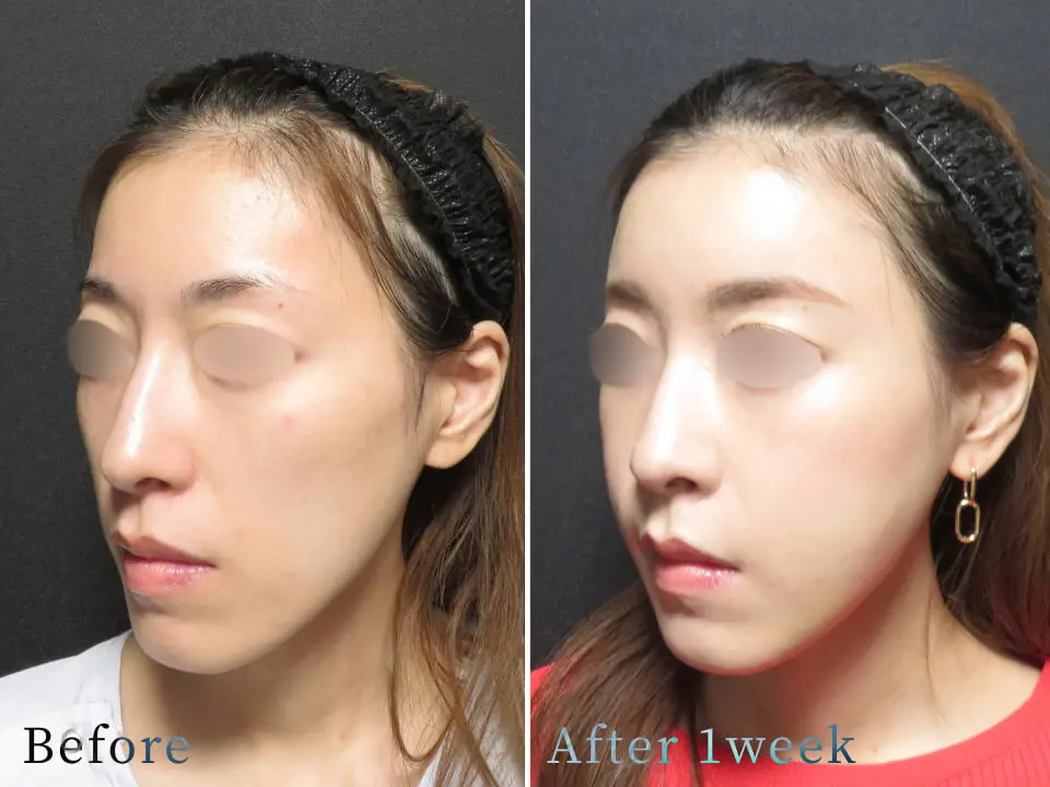 ビフォーアフター写真