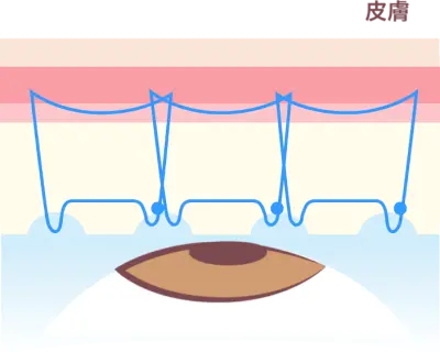 Xクロストリプル