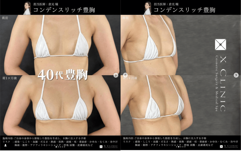 自然な豊胸1:脂肪注入豊胸