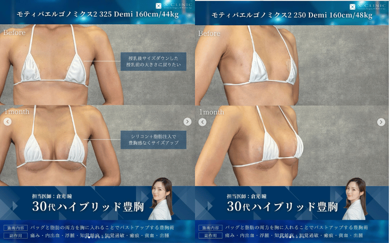 自然な豊胸2:ハイブリッド豊胸