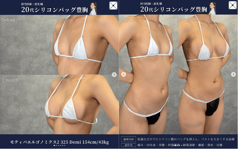 自然な豊胸3:シリコンバッグ豊胸