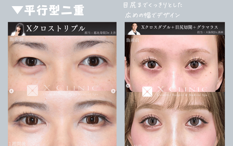 【平行二重の特徴】二重幅が均一