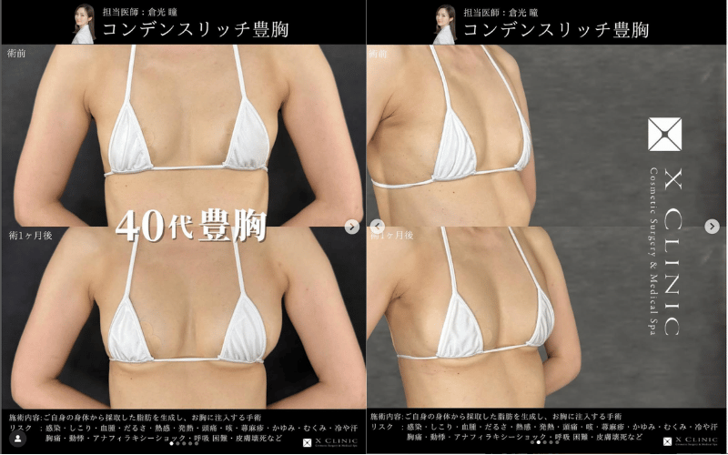 【症例写真】脂肪注入豊胸のビフォーアフター写真