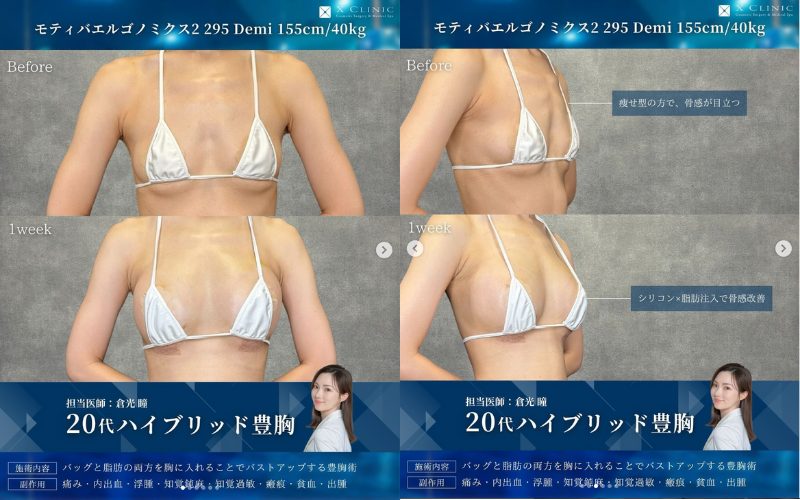 【症例写真】ハイブリッド豊胸のビフォーアフター