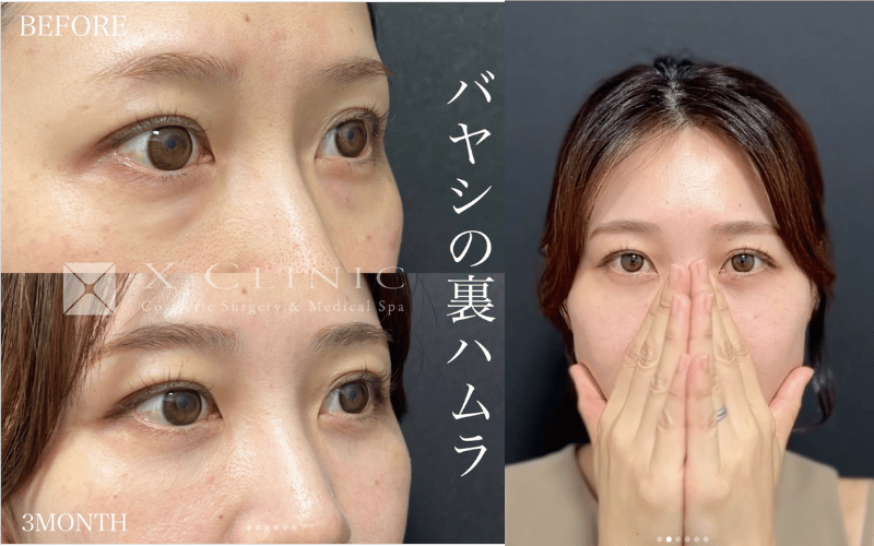裏ハムラ 症例