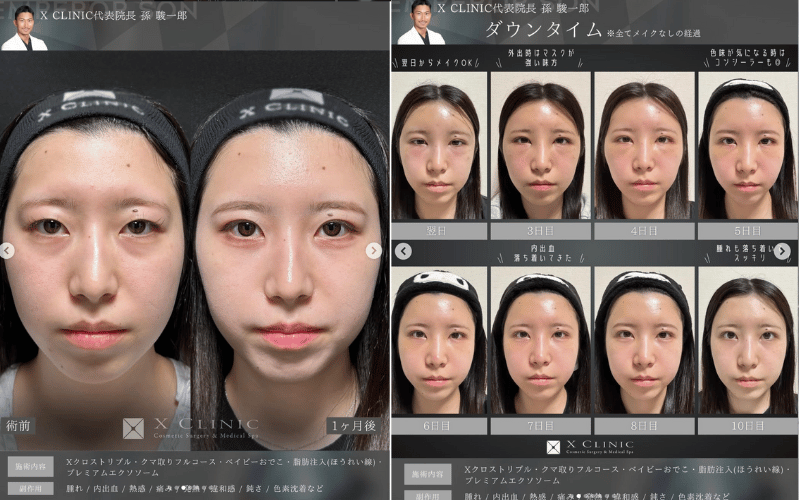 黒クマ 治療