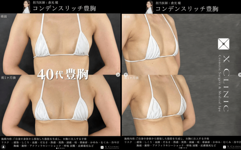 脂肪豊胸 症例写真