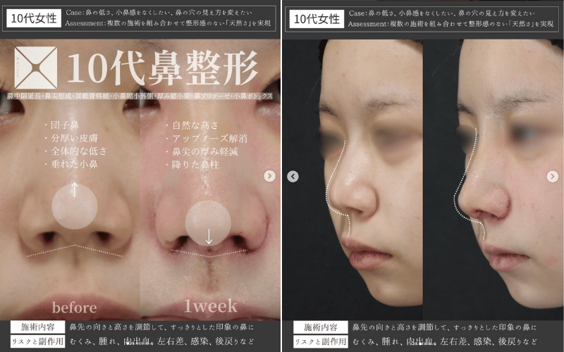 小鼻縮小 修正