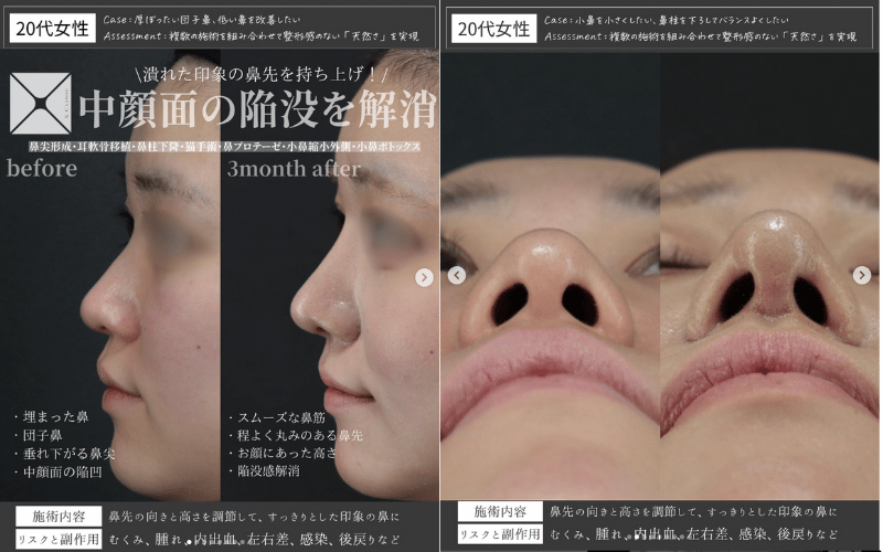 小鼻縮小 症例