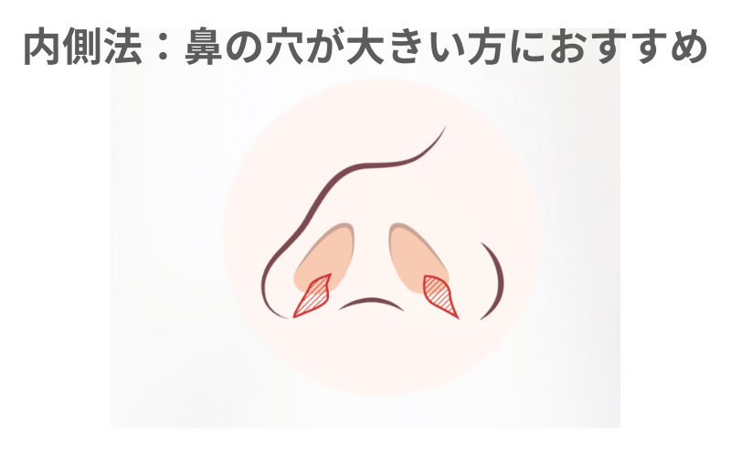 小鼻縮小 内側法 後戻り