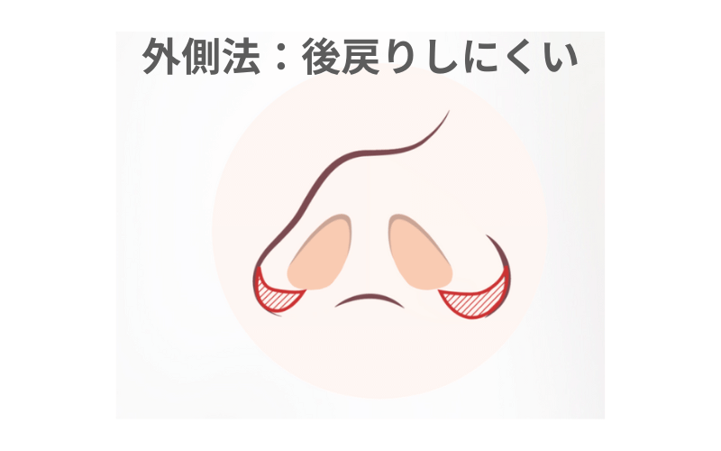 小鼻縮小 内側法 後戻り