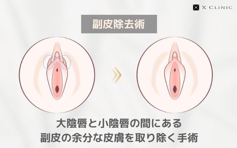 副皮切除 失敗
