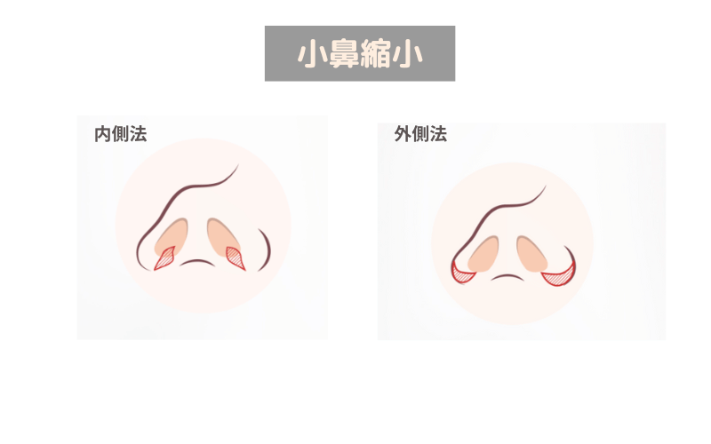 鼻尖形成 小鼻縮小 違い