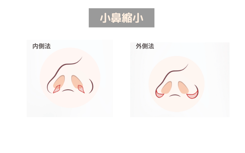鼻尖形成 のみ 小鼻縮小