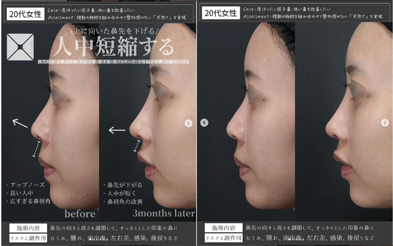 鼻尖形成 のみ 症例 画像