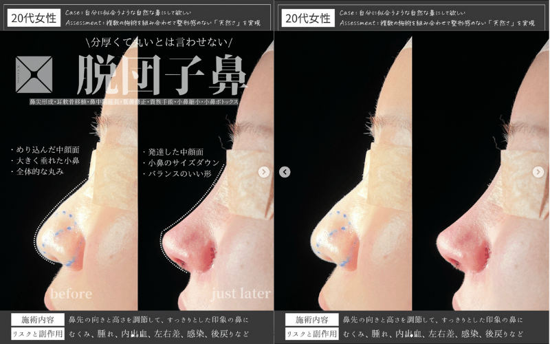 鼻尖形成 のみ 症例 写真