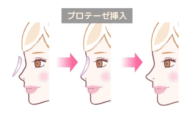 鼻尖形成 のみ プロテーゼ