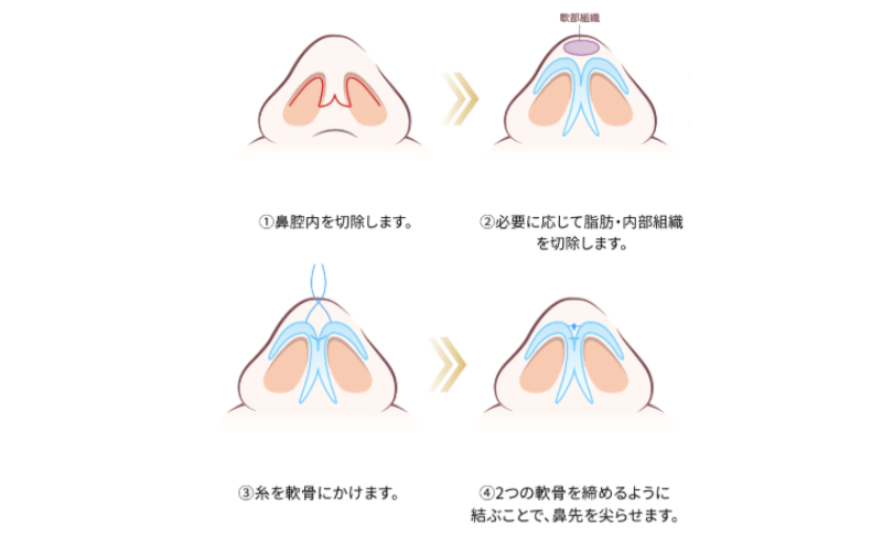 鼻尖形成 小鼻縮小 違い