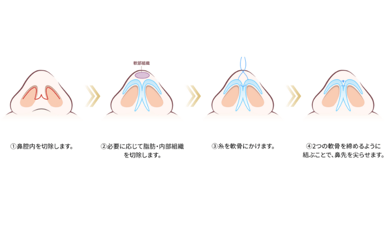 鼻尖形成 のみ
