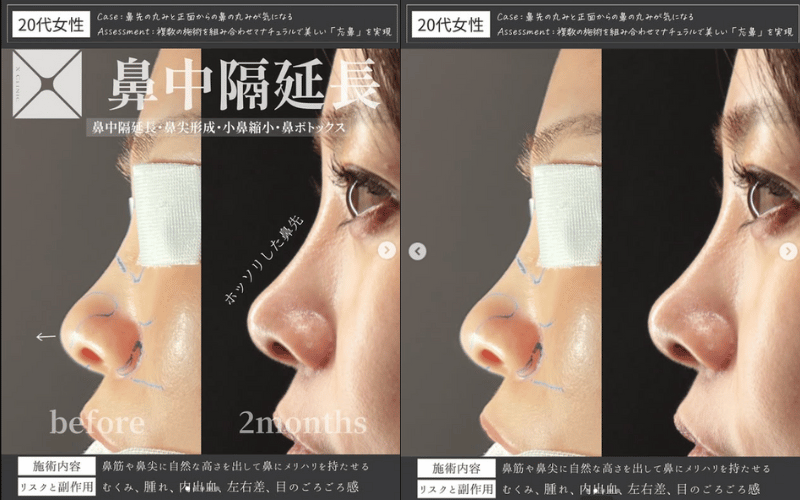 鼻中隔延長 症例写真