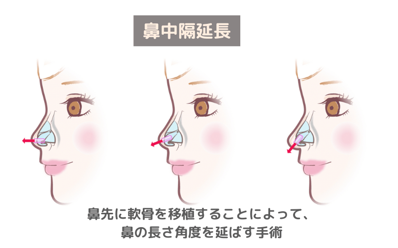 鼻中隔延長