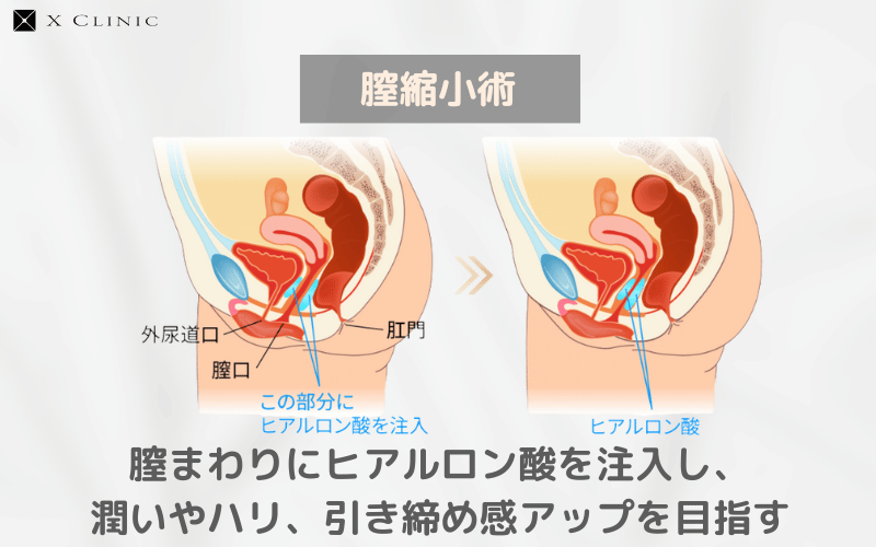 膣ヒアルロン酸
