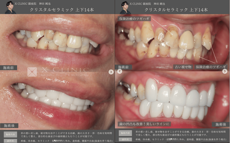 セラミック矯正 症例 ビフォーアフター
