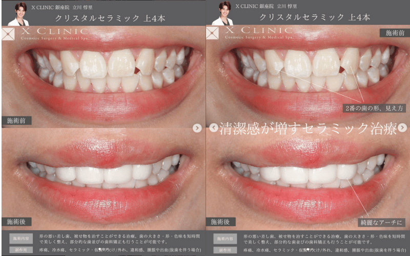 セラミック矯正 症例 ビフォーアフター