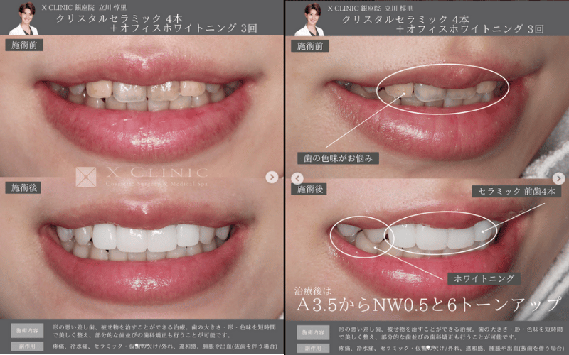 セラミック矯正 症例 ビフォーアフター