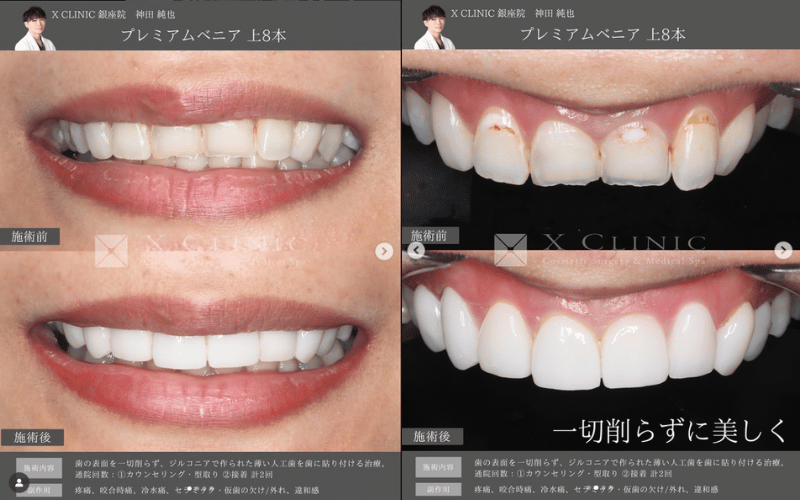 ラミネートべニア 症例