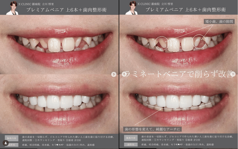 ラミネートべニア 症例