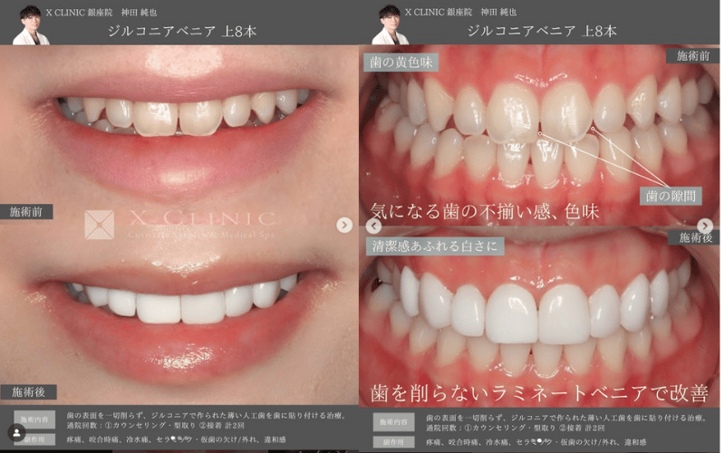 ラミネートべニア 症例