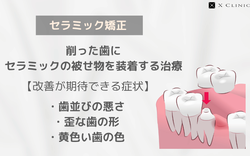 セラミック矯正 とは