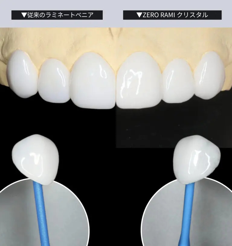 ZERO RAMI(ゼロラミ) – 歯を削らないセラミック(ラミネートベニア