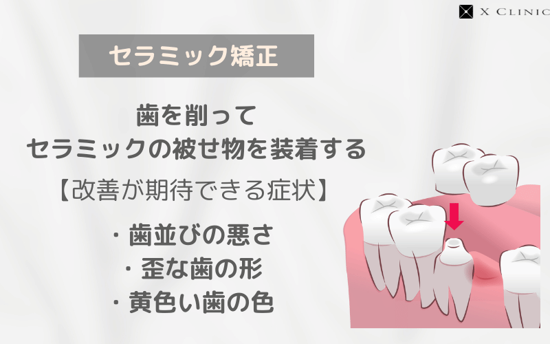 セラミック矯正 とは