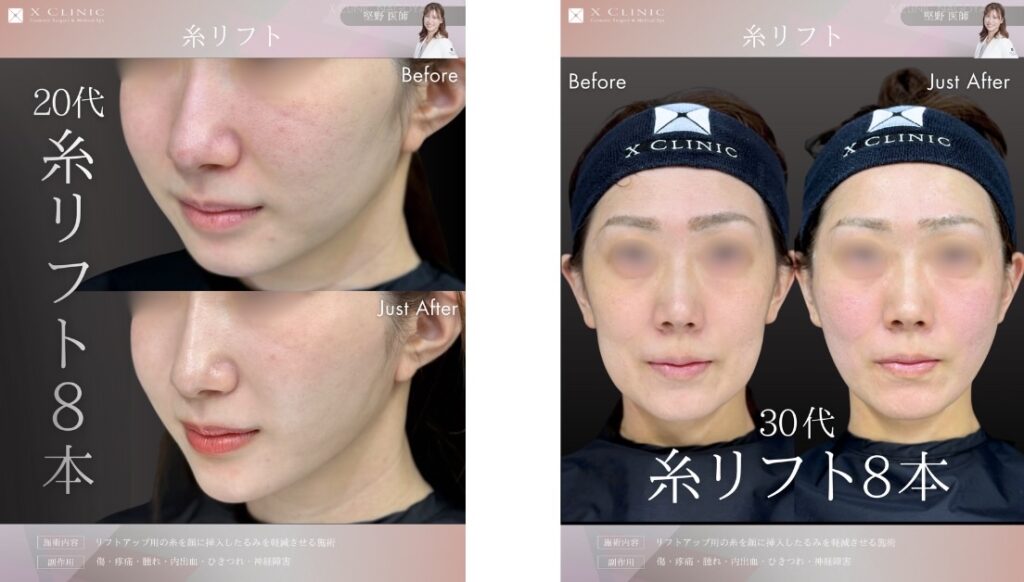 名古屋 糸リフト 名医