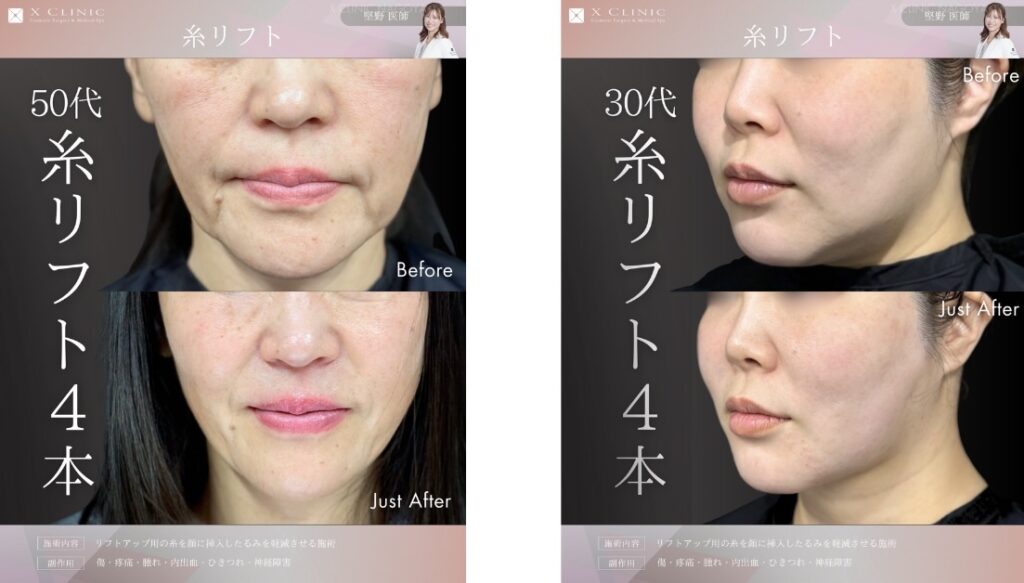 名古屋 糸リフト 名医