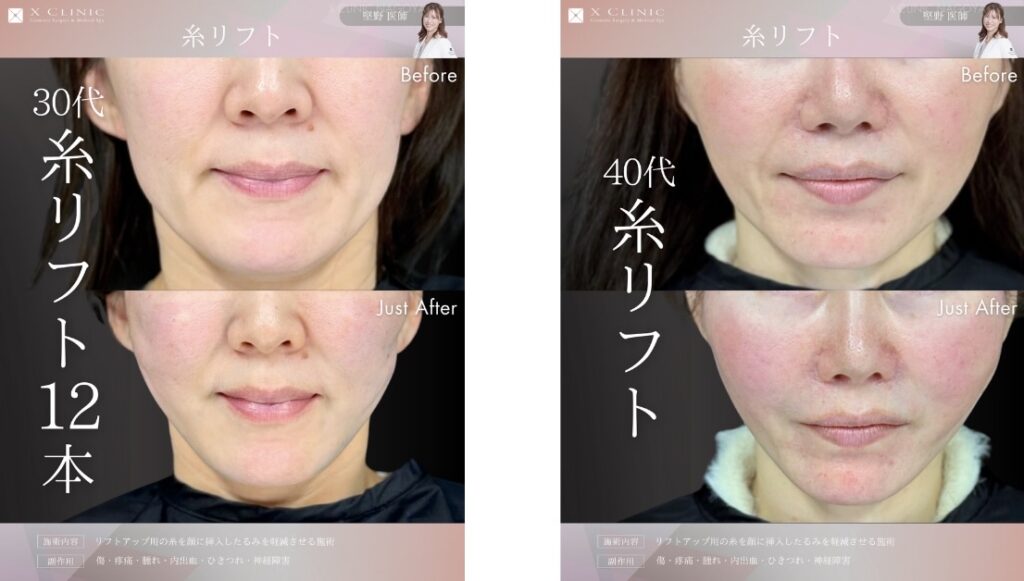 名古屋 糸リフト 名医