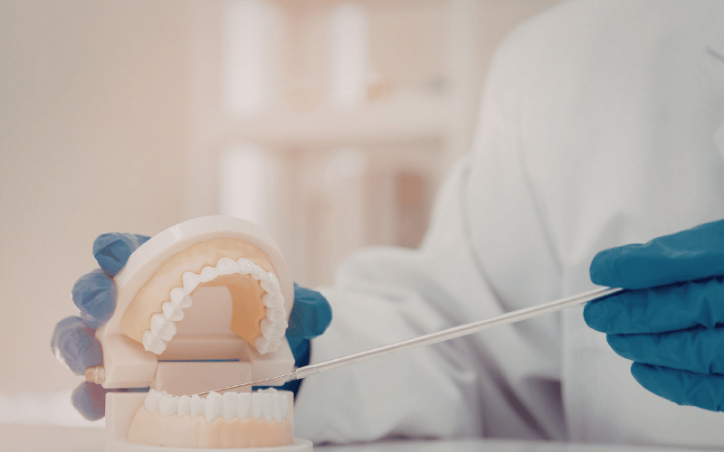 ラミネートべニア 寿命