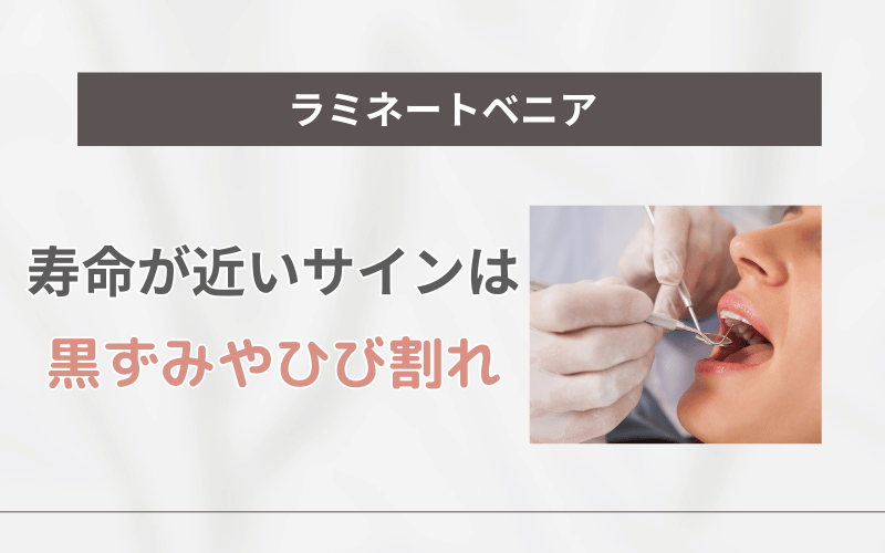 ラミネートべニア 寿命